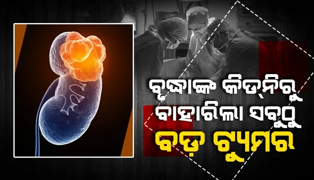 ଏଚଆଇଭି ପଜିଟିଭ ଥିବା ବୃଦ୍ଧାଙ୍କ କିଡନିରୁ ବାହାରିଲା ସବୁଠାରୁ ବଡ଼ ଟ୍ୟୁମର