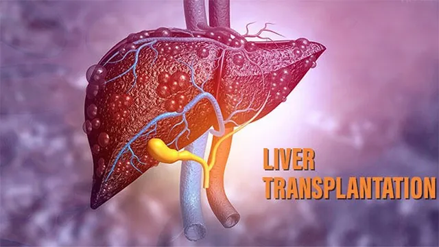 ରାଜ୍ୟରେ ଲିଭର ପ୍ରତିରୋପଣ ପାଇଁ ପୁଣି ନୂଆ ଆଶା: ପ୍ରତିରୋପଣ ଅପେକ୍ଷାରେ ୨୦୫ ରୋଗୀ