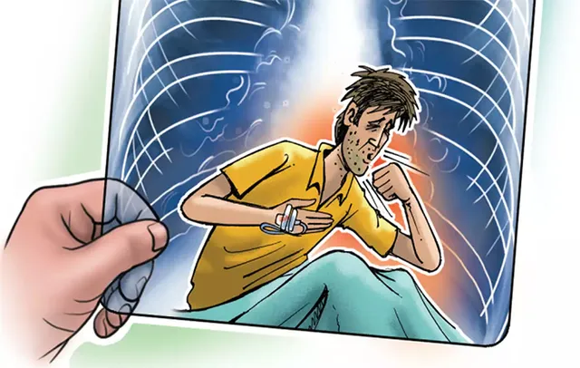 କୋରାପୁଟ ଜିଲ୍ଲାରେ ବଢ଼ୁଛନ୍ତି ଯକ୍ଷ୍ମା ରୋଗୀ: ୫ ବର୍ଷରେ ୧୧୮୫୯ ରୋଗୀ ଚିହ୍ନଟ