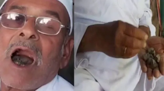 ଖୋଲା ଝରକା: ୩୧ ବର୍ଷ ହେବ ଖାଉଛନ୍ତି ଗୋଡ଼ି ପଥର