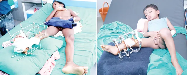 ‘ପଦ୍ମିନୀ କେୟାର୍‌’ରେ ସଫଳ ଅସ୍ତ୍ରୋପଚାର, ଦୁଇ ଜନ୍ମଗତ ଦିବ୍ୟାଙ୍ଗ ଶିଶୁ ପାଇବେ ନୂଆ ଜୀବନ