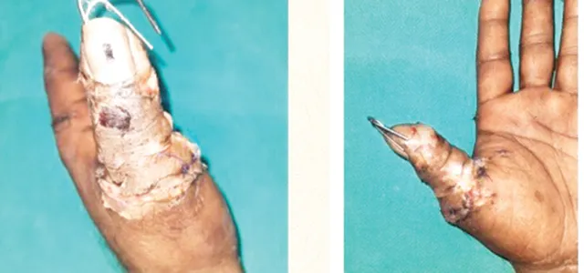 ଏମ୍‌ସରେ ପ୍ରଥମ: ଯୋଡ଼ା ହେଲା ବୁଢ଼ା‌ ଆଙ୍ଗୁଠି