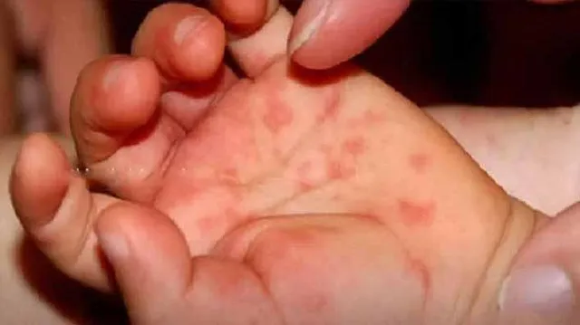 ଏଚ୍‌ଏଫ୍‌ଏମ୍‌ଡି ବ୍ୟାପୁଛି: ଅଗଷ୍ଟରେ ଶୀର୍ଷ ଛୁଇଁବ!