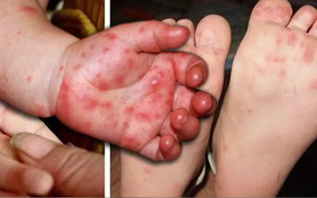 ଚିନ୍ତା ବଢ଼ାଇଲାଣି ଏଚ୍‌ଏଫ୍‌ଏମ୍‌ଡି: ବଢ଼ୁଛି ଆକ୍ରାନ୍ତ ଶିଶୁଙ୍କ ସଂଖ୍ୟା, ରିପୋର୍ଟ ମାଗିଲା ସ୍ବାସ୍ଥ୍ୟ ବିଭାଗ