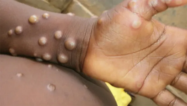 ଦେଶରେ ମଙ୍କିପକ୍ସ ମାମଲା ୮କୁ ବୃଦ୍ଧି: ଦିଲ୍ଲୀରେ ତୃତୀୟ, କେରଳରେ ପଞ୍ଚମ ମାମଲା