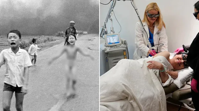 ୫୦ ବର୍ଷ ପରେ ଶେଷ ହେଲା ‘ନେପାମ୍‌ ବୋମା’ ମାଡ଼ରେ ଆହତ ହୋଇଥିବା ୯ ବର୍ଷୀୟ ଭିଏତ୍‌ନାମୀ ବାଳିକାର ଚର୍ମ ଚିକିତ୍ସା