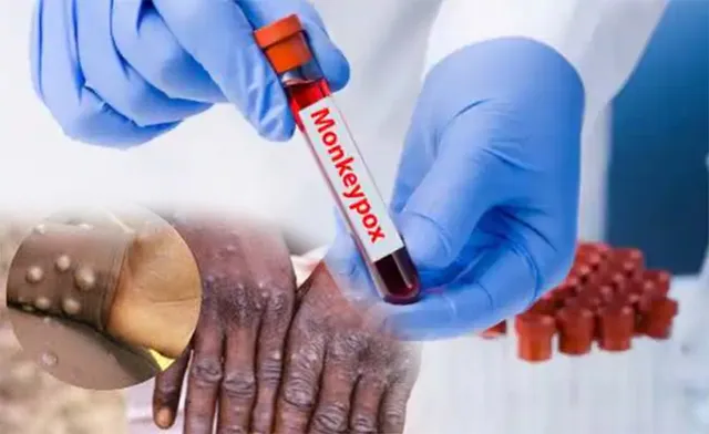 ମଙ୍କିପକ୍ସକୁ ନେଇ ଆମେରିକାର ଚିନ୍ତା ବଢ଼ିଲା