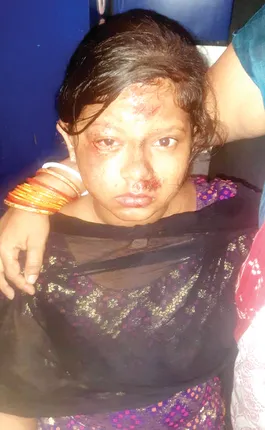 ରାସ୍ତା ମରାମତି କରିବାକୁ ଭୁଲିଗଲା ଜାଇକା, ଖାଲରେ ପଡ଼ି ୨ ଭଉଣୀ ଆହତ