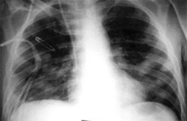 ଆଲକାଲାଇନ ସଏଲ ଫଙ୍ଗସ ସଂକ୍ରମିତ ବିଶ୍ବର ପ୍ରଥମ ବ୍ୟକ୍ତି ଖୋର୍ଧାରୁ ଚିହ୍ନଟ