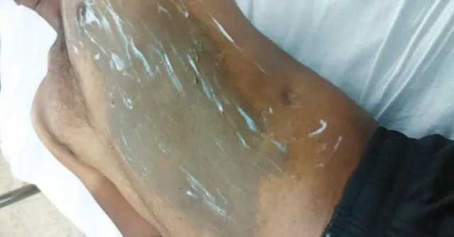 ଟ୍ୟୁସନ୍‌ ଫିକୁ ନେଇ ଯୁବକଙ୍କୁ ଏସିଡ୍ ମାଡ଼, ଦମ୍ପତି ଗିରଫ