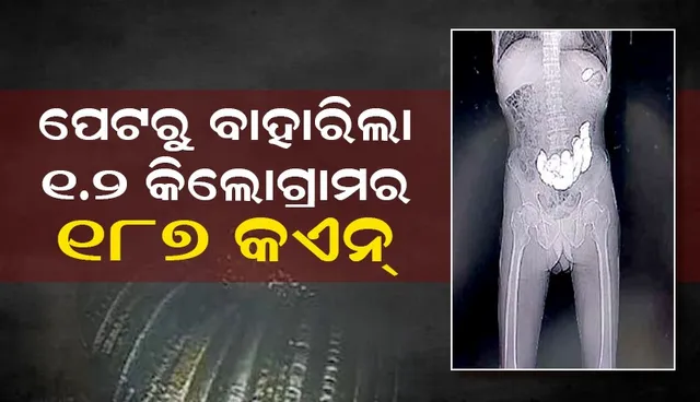 ଯନ୍ତ୍ରଣା ହେବାରୁ ଯାଇଥିଲେ ହସ୍ପିଟାଲ, ପେଟରୁ ବାହାରିଲା ୧୮୭ଟି କଏନ