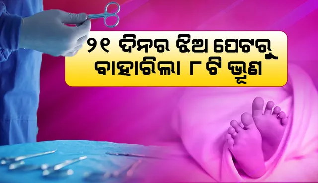 ୨୧ ଦିନର ଶିଶୁ ପେଟରେ ୮ଟି ଅବିକଶିତ ଭ୍ରୂଣ