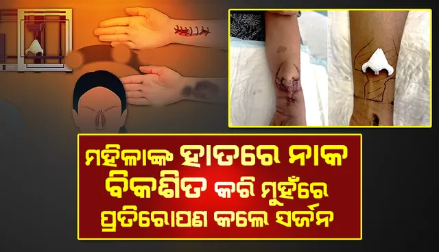 ମହିଳାଙ୍କ ହାତରେ ନାକ ବିକଶିତ କରି ମୁହଁରେ ପ୍ରତିରୋପଣ କଲେ ଫ୍ରାନ୍‌ସର୍‌ ସର୍ଜନ୍‌