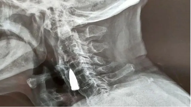 ଏକ୍ସ-ରେରୁ ଜଣାପଡିଲା ଦ୍ଵିତୀୟ ବିଶ୍ବଯୁଦ୍ଧ ସମୟରୁ ଫସିଯାଇଥିବା ଗୁଳି