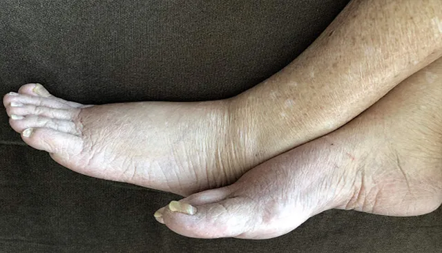 ଗୁଡ଼ଭେଲାରେ ବ୍ୟାପୁଛି ଫାଇଲେରିଆ, ୩ ରୋଗୀ ଚିହ୍ନଟ