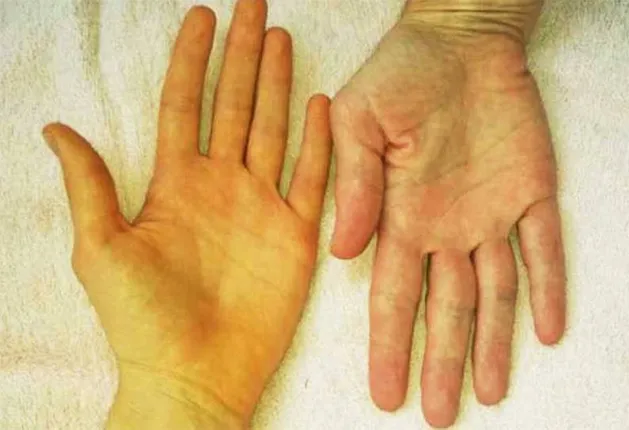 ସୁନ୍ଦରଗଡ଼ରେ କାୟା ମେଲାଇଲାଣି ଜଣ୍ଡିସ୍‌: କୋଇଡ଼ା ଓ ଲହୁଣିପଡ଼ାରେ ୪୦ରୁ ଅଧିକ ଚିହ୍ନଟ