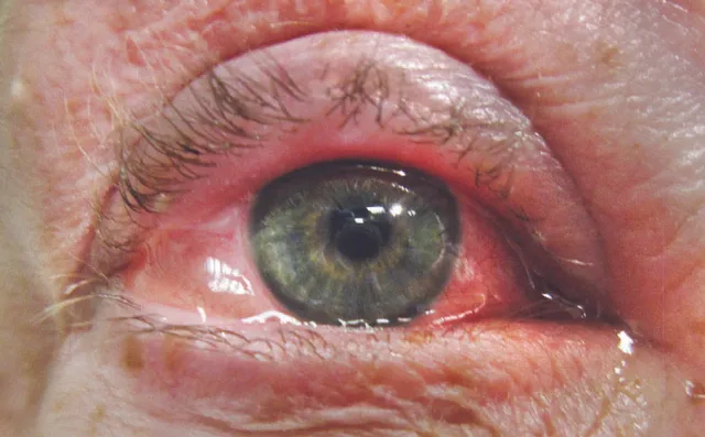 ମାଡ଼ୁଛି ଆଖିଧରା ରୋଗ; ଚଳିତମାସ ଗୁରୁତ୍ବପୂର୍ଣ୍ଣ