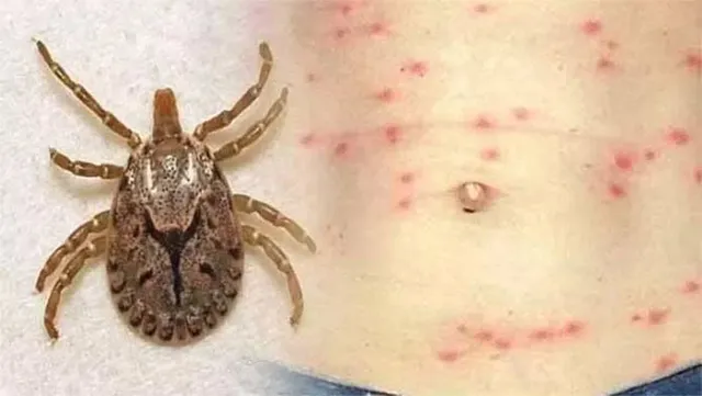 ମାଡ଼ିଲାଣି ସ୍କ୍ରବ୍ ଟାଇଫସ୍‌: କୀଟ କାମ଼ୁଡୁଛି, ପ୍ରାଣ ଯାଉଛି