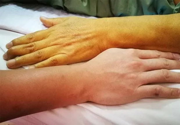 ଯନ୍ତ୍ରଣାବିହୀନ ଜଣ୍ଡିସ୍ ହୋଇପାରେ ଅଗ୍ନାଶୟ କର୍କଟର କାରଣ