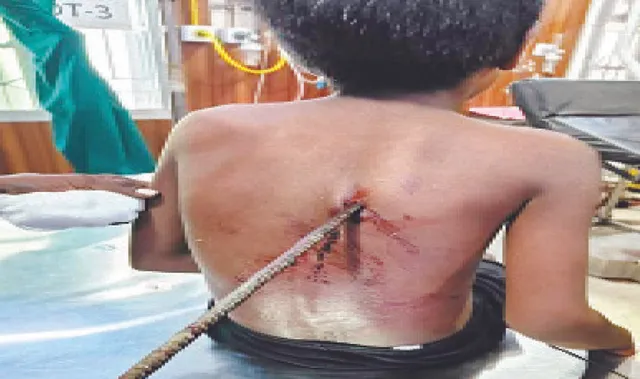 ଖେଳୁଥିବା ବେଳେ ପିଠିରେ ପଶିଗଲା ଲୁହାଛଡ଼: ବୁର୍ଲାରେ ବାହାର କରାଗଲା, ପିଲା ସୁସ୍ଥ ଥିବା ସୂଚନା