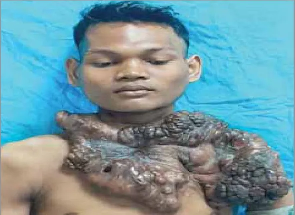 ଏସ୍‌ସିବିରେ ବିରଳ ଅସ୍ତ୍ରୋପଚାର: ଛତିଶଗଡ଼ର ଯୁବକଙ୍କ ଛାତିରୁ କଢ଼ାଗଲା ୫ କେଜିର ଟ୍ୟୁମର