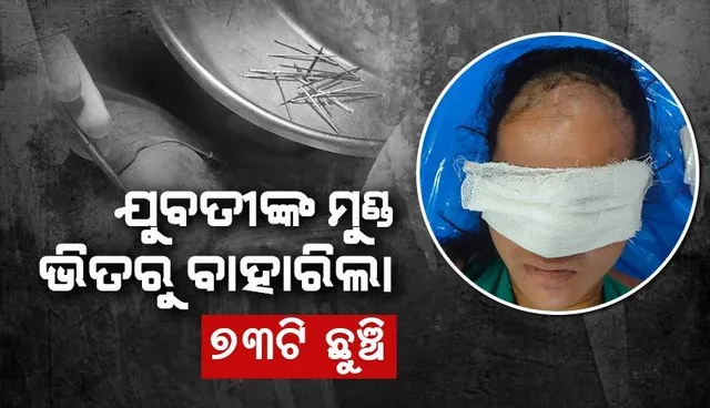 ଭିମସାରରେ ଯୁବତୀଙ୍କ ଅସ୍ତ୍ରୋପଚାର: ମୁଣ୍ଡ ଭିତରୁ ବାହାର କରାଗଲା ୭୩ଟି ଇଞ୍ଜେକେସନ ଛୁଞ୍ଚି