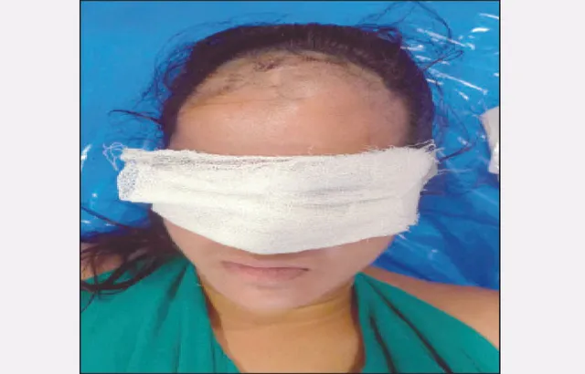 ଆଜି ପୁଣି ଯୁବତୀଙ୍କ ମୁଣ୍ଡରୁ ବାହାରିଲା ୭ଟି ଛୁଞ୍ଚି: ଗୁଣିଗାରେଡ଼ିର କରୁଣ ପରିଣତି