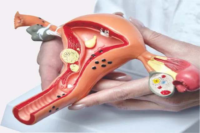 ଜରାୟୁ କର୍କଟ ପଛରେ ବଦଭ୍ୟାସ!