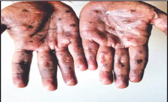 ସ୍ବିଡେନ ପରେ ପାକିସ୍ତାନରେ ଏମ୍‌ପକ୍ସ: ୟୁଏଇରୁ ଫେରିଥିବା ପାକିସ୍ତାନର ୩ ରୋଗୀ ଏମ୍‌ପକ୍ସ ପଜିଟିଭ୍