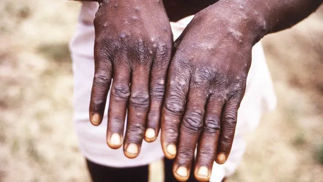 মাঙ্কিপক্স রোধে স্মলপক্সের টিকায় ছাড়