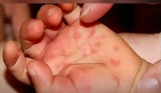 টমেটো ফ্লু কি? কেরালায় ৮০ টিরও বেশি শিশু এই রোগে আক্রান্ত