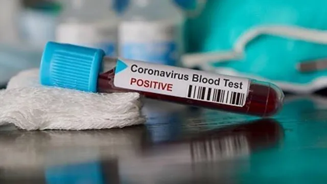 কোভিড পজিটিভ রেলের ২১জন চিকিৎসক