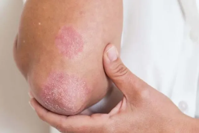 ক্যান্সারের চেয়ে ছত্রাক সংক্রমণে বেশি লোকের মৃত্যু হচ্ছে