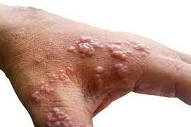 কানাডায় বাড়ছে মাঙ্কিপক্সের প্রকোপ