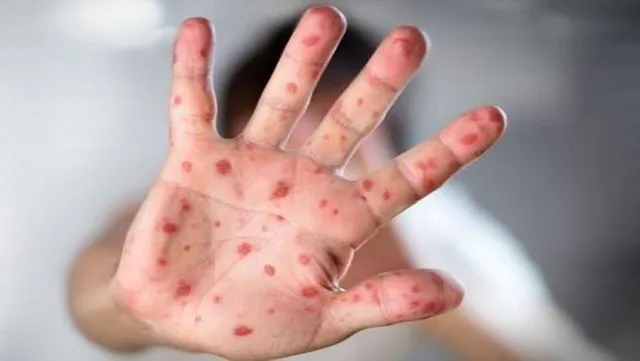 হামের দৌরাত্ম্য মহারাষ্ট্রে