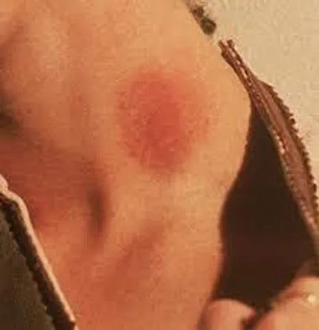 হিকি কি বেদনাদায়ক?