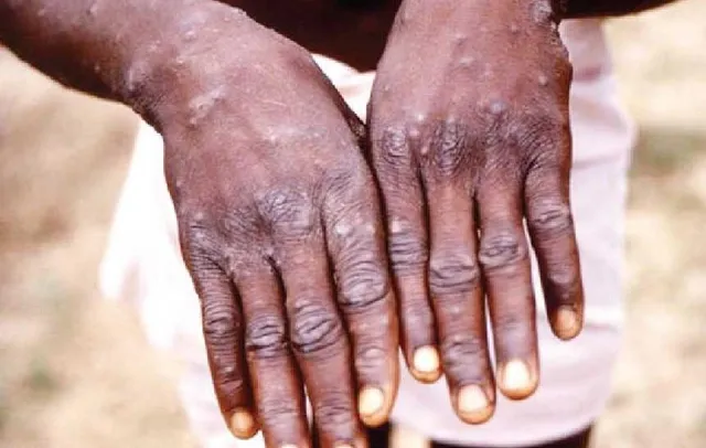 মাঙ্কি পক্সের হানা ঠেকাতে কড়া পদক্ষেপ কেন্দ্রের