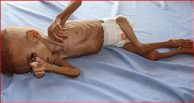 বাগে আসছে না অনাহার, প্রতি ৫ মিনিটে মৃত্যু হচ্ছে ১ শিশুর