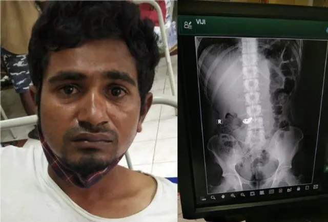 সোনার চেন গিলে নিল চোর, তারপর.........