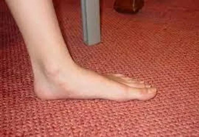 ফ্ল্যাট ফুট কী?