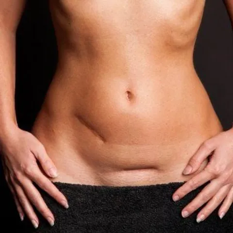 প্রোল্যাপসের জন্য সার্জারি?