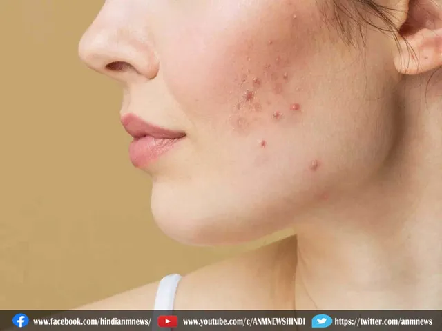 pimple home remedies