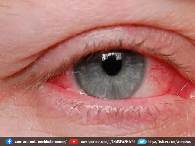 eye flu e