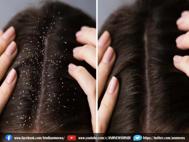dandruff household paste.