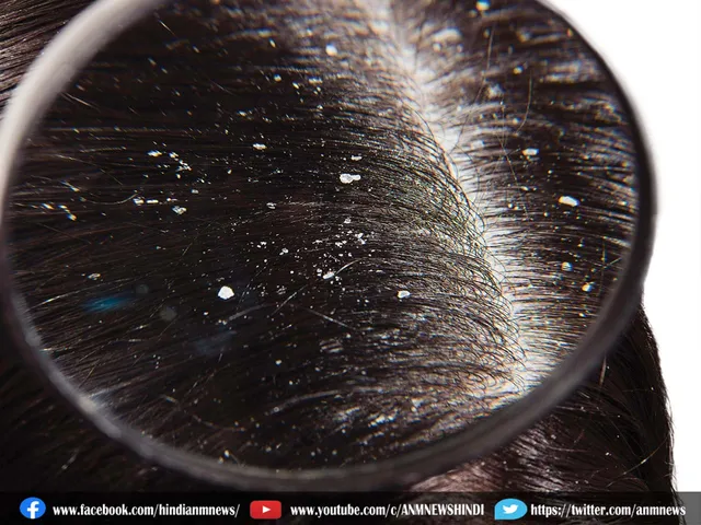 dandruff