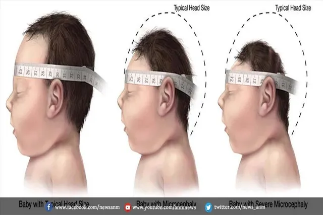 क्या आप जन्मजात जीका सिंड्रोम के बारे में जानते हैं