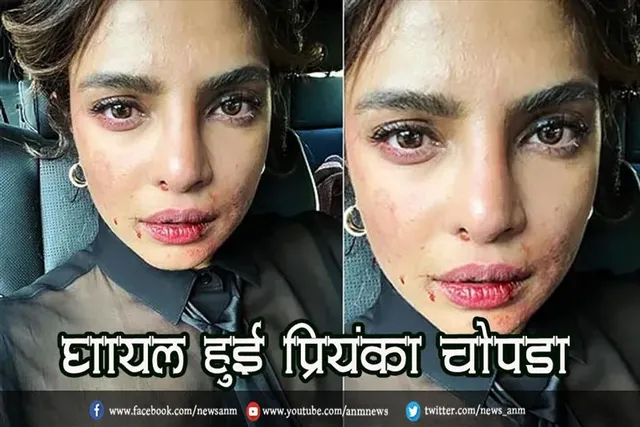 घायल हुई प्रियंका चोपड़ा