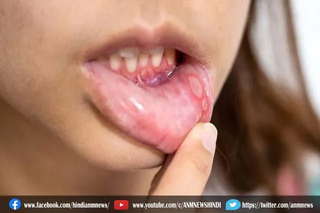 मुंह के छाले से है परेशान, खाए ये फूड