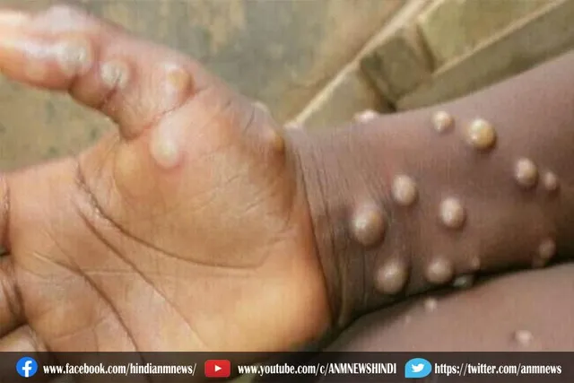 मंकीपॉक्स के मामलों की संख्या 1,076 तक पहुंच गई