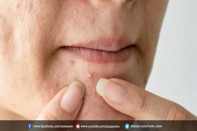 क्या आप पिंपल्स से परेशान हैं तो करे ये काम